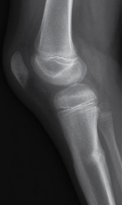 femur groeischijf epifyse tibia fibula sclerose periostale verandering FIGUUR 1 Röntgenfoto van rechter knie en onderbeen van patiënt A bij wie het vermoeden bestaat op een bottumor.