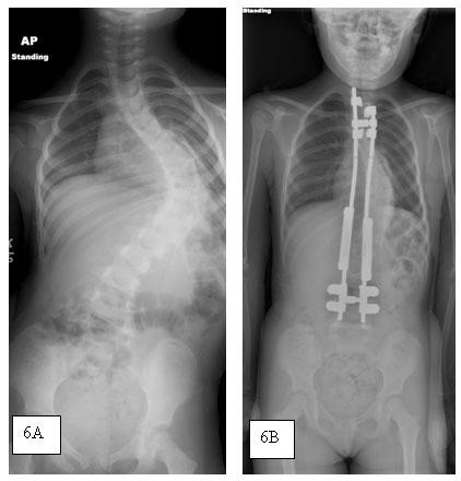 Distractie-systeem of SpineGuide-systeem Het doel van de operatie bij JIS is de bochten te corrigeren en verdere vervorming van de borstkas te stoppen.
