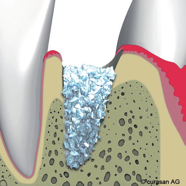 5 De verschillende soorten behandelingen Tand- of kiesextractie: Na het verwijderen van de tand of kies wordt de ontstane holte gevuld met botkorrels.