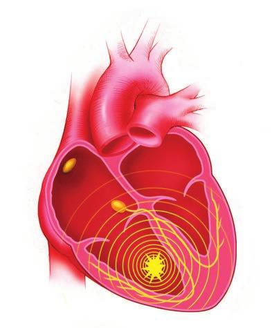 Abnormale elektrische signalen vanuit het ventrikel Figuur 3. Een voorbeeld van ventriculaire tachycardie. VT kan soms worden behandeld met medicijnen.