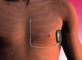 Elektrode parallel aan borstbeen Aansluiting pulsgenerator: linkerkant van de ribbenkast Figuur 5.