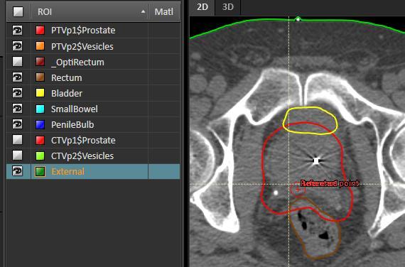 Deventer: Auto Prostaat Auto Prostaat: +/- vesiculae +/- sigmoid