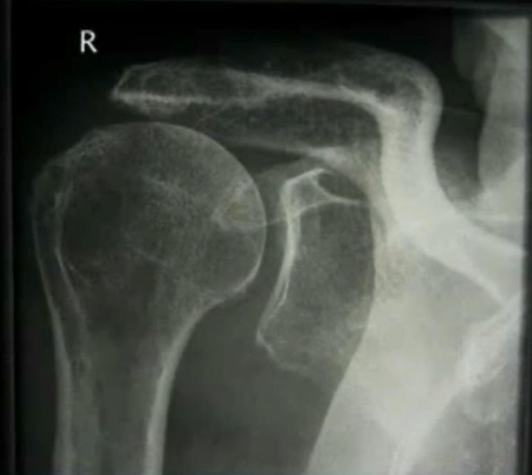 Reversed Totale schouder: Postop: Geleid actief AF/Abd 3-4 wk wk - Reconstructie