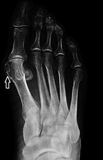 PATIËNTENINFORMATIE Afbeelding links: röntgenfoto van een scheefstand van de grote teen met bobbel vóór de operatie Afbeelding rechts: röntgenfoto van de