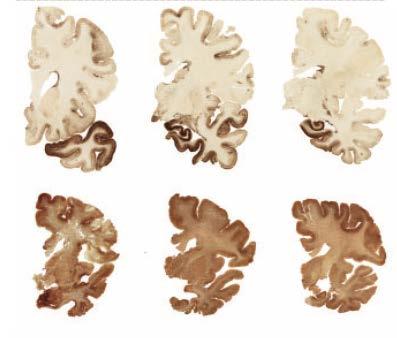 The spectrum of disease in chronic traumatic