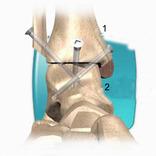 De operatiemethoden De verschillende operatiemethoden hebben met elkaar gemeen dat het resterende deel van de versleten kraakbeenlaag van het enkelgewricht wordt verwijderd.