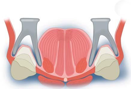 Van Waas: Anatomie en afdrukprocedure Thema: De volledige gebitsprothese nader belicht 1 pharyngeus constrictor superior Afb. 2.