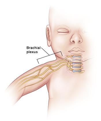 Uw kindje heeft bij de geboorte een plexus brachialis letsel opgelopen. Hierdoor heeft het een gehele of gedeeltelijke verlamming van de schouder, arm of hand aan één zijde.