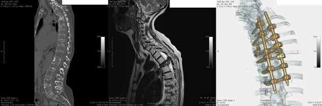 A B C Figuur 1. Sagittale CT en T2-MRI-coupes van patiënte met gemetastaseerd niercelcarcinoom. Inzakking wervel Th5 met versterkte kyfosering en compressie van het myelum.