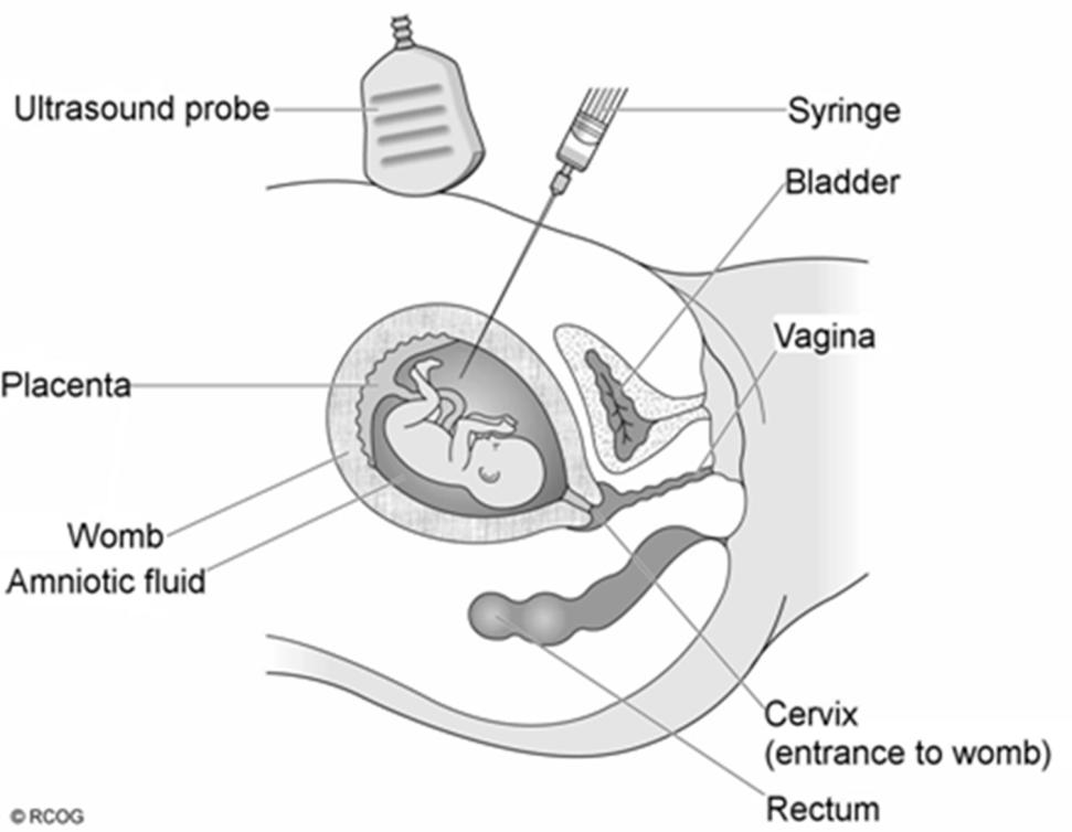 Vruchtwaterpunctie invasieve test Invasieve prenatale testen zijn beschikbaar sinds de vroege 60-er jaren, aanvankelijk voor chromosomale afwijkingen, later voor monogene aandoeningen Materiaal van