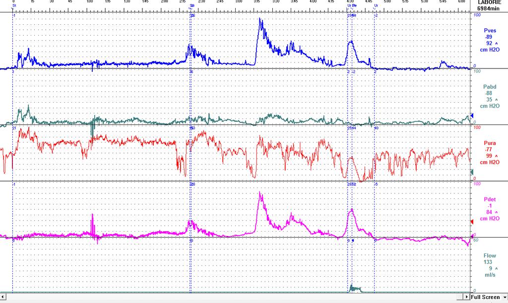 1 Vullingsfase: 70 ml Compliance: 9,8 ml/cmh 2 O bij 70 ml Detrusor: