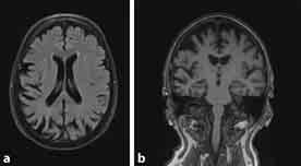 6 Ondersteuning bij visuele problemen in het kader van posterieure corticale atrofie een casus Concluderende bevindingen en beleid Figuur 1 MRI van een willekeurige PCA-patiënt.