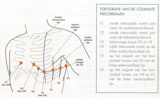 6.4.2 Positie precordiale elektroden: OPGELET In tegenstelling tot de ledematenelektroden waar de plaats van de elektrode op het lidmaat geen noemenswaardige invloed heeft op de morfologie van het