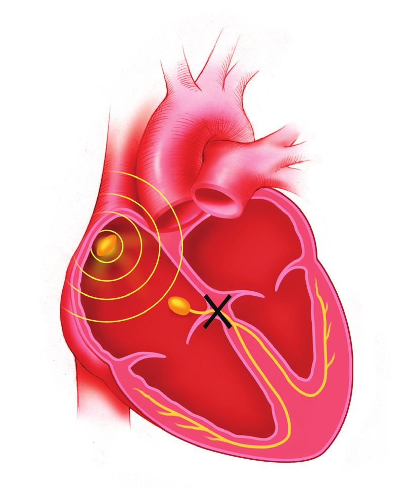 Bradycardie Soms klopt het hart te langzaam. Dit kan veroorzaakt worden door het niet goed werken van de sinusknoop of door een aandoening die hartblok genoemd wordt (Figuur 3).