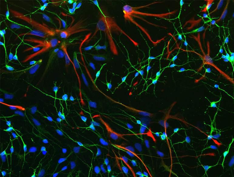 pathologie Neuronen + Astrocyten