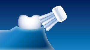 Zachte reiniging van tanden en tandvlees Smartimer Philips Sonicare-tandenborstel met Sensitive-poetsstand: poetsstand voor zachte, maar grondige reiniging van