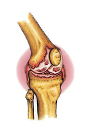 1. Inleiding U bent door de orthopeed op de wachtlijst geplaatst voor een hemi (halve) knieprothese. Dit informatieboekje is bedoeld om u zo goed mogelijk voor te bereiden op de operatie.