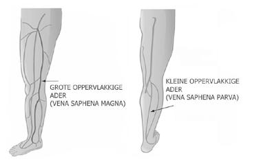 Laserbehandeling (EVLT) van spataderen 3 De grote oppervlakkige ader (vena saphena magna) loopt vanaf de binnenzijde van de enkel naar de lies (zie figuur 2). Uit deze ader ontspringen veel zijtakken.