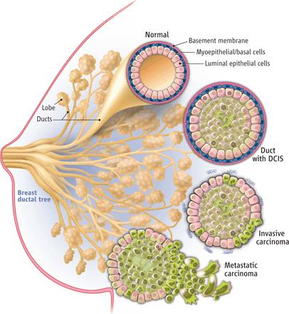 Wat is DCIS? Mogelijke voorloper van borstkanker Afwijkende cellen beperkt tot het melkgangstelsel >80% gevonden bij bevolkingsonderzoek Calcificaties DCIS - Jaarlijks >4.