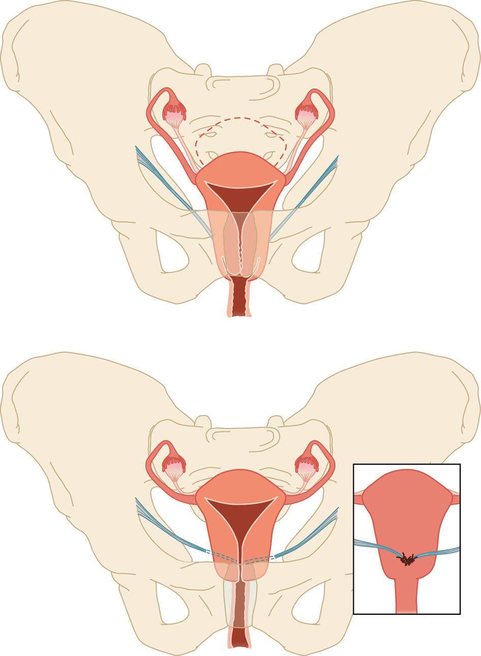 ONDERZOEK studie was er 1 jaar na de ingreep in anatomisch resultaat tussen patiënten die abdominale hysteropexie en degenen die vaginale hysterectomie hadden ondergaan (n = 82).
