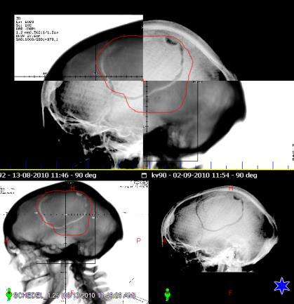 De bestralingsdeskundigen op het toestel vergelijken deze foto s met de foto s die op de CT-scan
