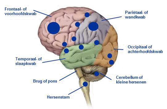 Uitzaaiingen in de hersenen In Nederland wordt per jaar bij circa 10.000 volwassenen uitzaaiingen in de hersenen vastgesteld.