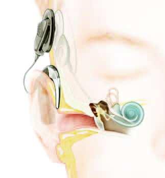Figuur 2 Een cochleair implantaat banen reeds gevormd zijn, kan van bilaterale CI s een goed resultaat verwacht worden.