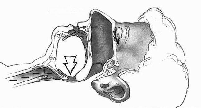 Situatie zonder CPAP-apparaat: de tong zakt naar achter en sluit de luchtweg af.