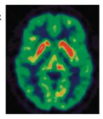 Onderzoek in het UMCG 2. Wij denken dat het stofje serotonine in de hersenen meespeelt bij de klachten Waarom?