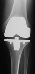 Al het kraakbeen van het boven- en onderbeen wordt afgezaagd en het bot van het boven- en onderbeen worden verder voorbereid voor het kunnen plaatsen van de prothese.