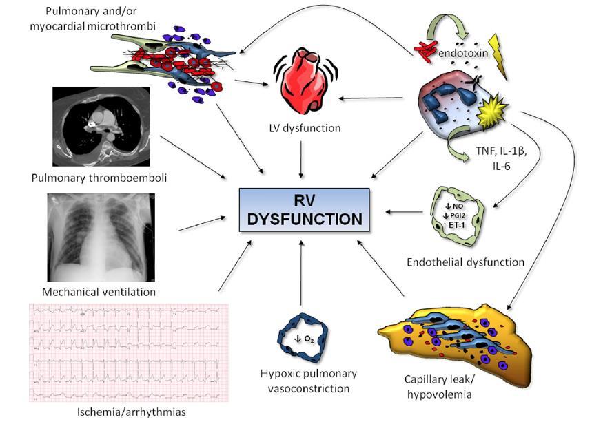 Pathofysiologie Ventriculaire interdependentie Afterload Inflammatie Preload Contractiliteit Lahm T et