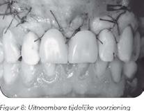 Om ingroei van tandvlees te voorkomen, wordt een membraan over het kunstbot