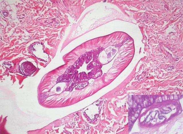 Fig. 7 : De aanwezigheid van een vrouwelijke nematode in een biopt van een nodulair letsel (uit Pardon et al.