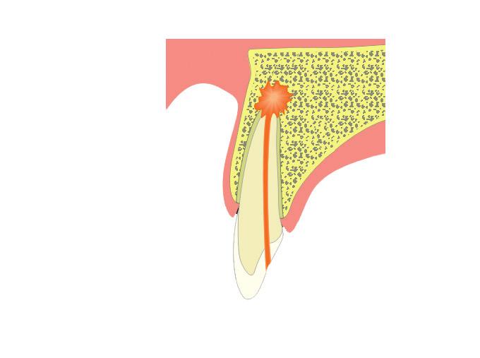 Wat is een cystectomie? Een kaakcyste kan voorkomen in samenhang met een tand of los van de tand. Cysten die zich los van de tand vormen, worden verwijderd zonder de tand aan te raken.