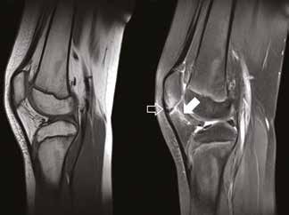 Figuur 1B: Sagittale snede van conebeam-ct-onderzoek van de knie. Bevestiging van ossificatie aan de oorsprong van de patellapees (volle pijl).