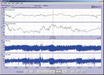 Figuur 1: Het scherm van de monitor is in 2 delen verdeeld. De bovenste helft toont het standaard-eeg-signaal in real time via 2 kanalen, één voor de rechter- en één voor de linkerhemisfeer.