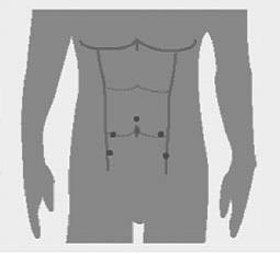 In het Antoni van Leeuwenhoek wordt de operatie uitgevoerd met behulp van een operatie robot. De robot vertaalt de operatiebewegingen van de chirurg met extreme precisie.