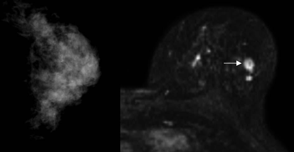 A B Figuur 1. Mammografie en MRI van de linkerborst van een vrouw (37jaar) die vanwege een familiaire belasting voor het krijgen van een mammacarcinoom jaarlijks met beide technieken wordt gescreend.