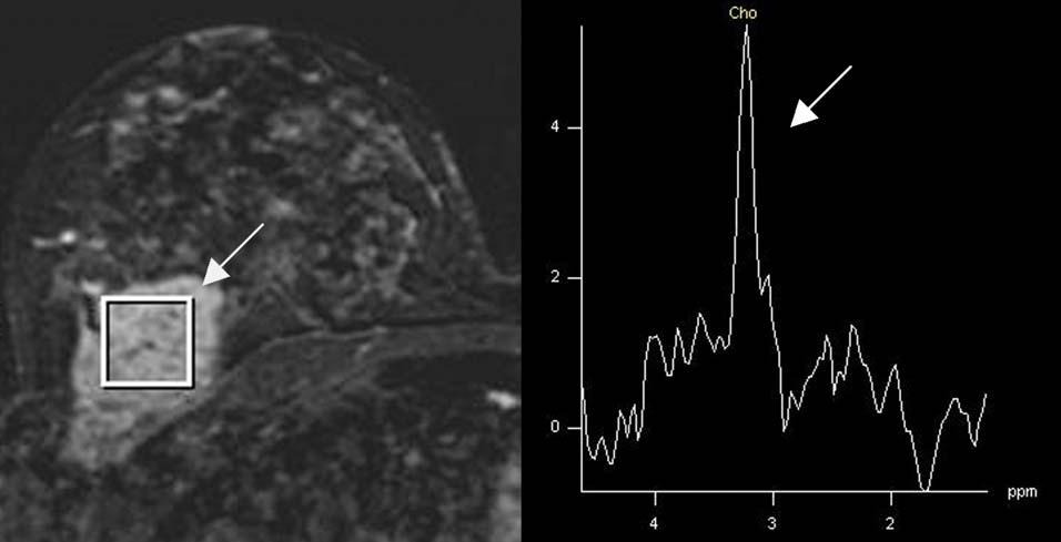 A B Figuur 4. Detectie van choline in de mamma met MRI-spectroscopie. A. MRI van een mamma toont een transversale subtractie van een groot invasief ductaal carcinoom in de rechtermamma (pijl).