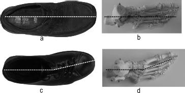 Figuur 10a t/m d.. a en c: Geproneerde stand van de voet. b en d: Gesupineerde voet, de voorvoet vertoont een naar mediaal gerichte deviatie.