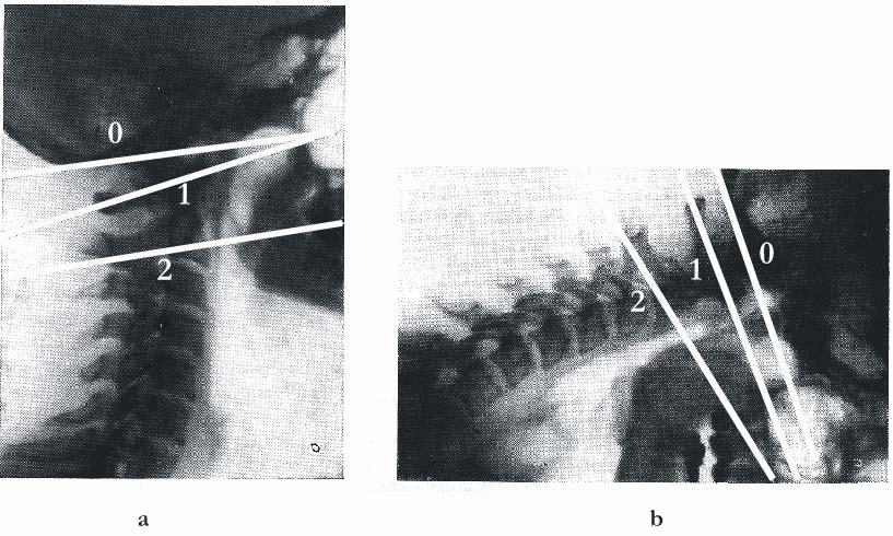 van de schedel en de processi spinosi van de cervicale wervels (figuur 4). Het ligament is homoloog met het lig. supraspinale van de thoracale en lumbale wervelkolomdelen. Figuur 3.