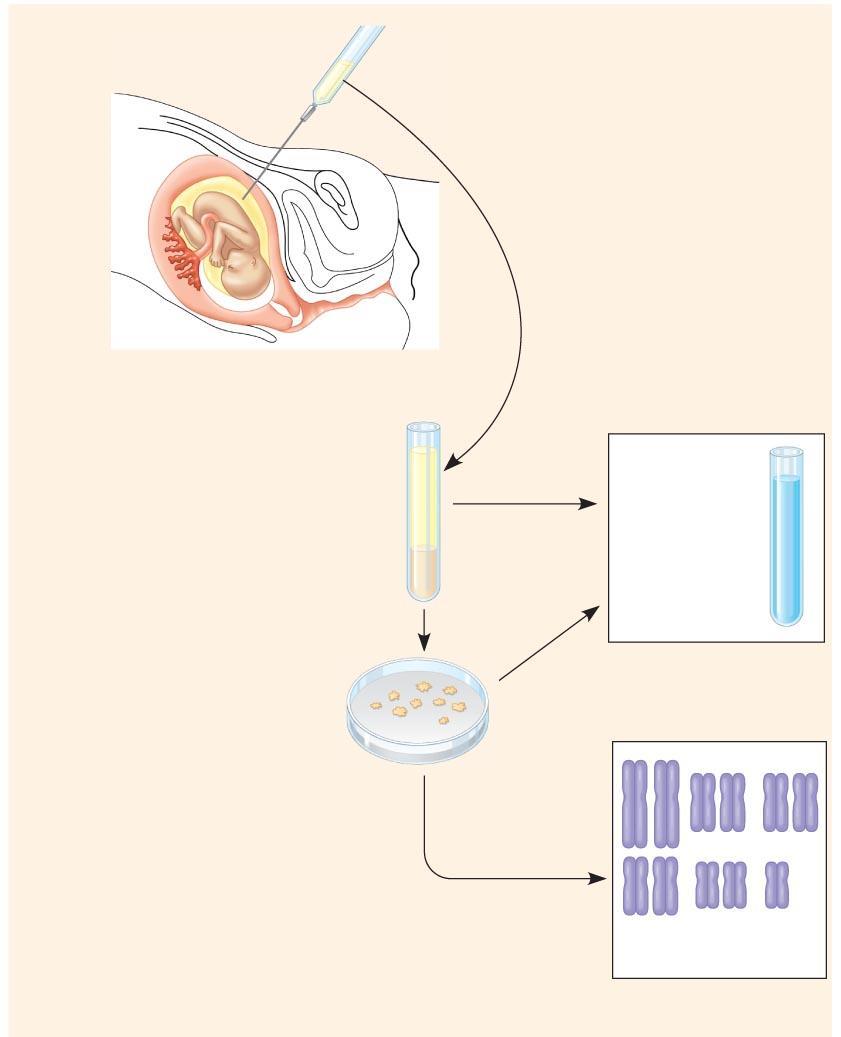 Foetus Vruchtwater punctie Welke mogelijkheden?