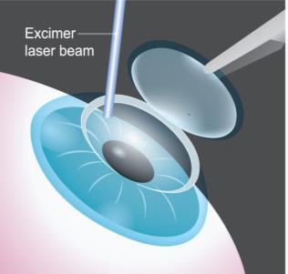 Dankzij de uitzonderlijke precisie van de femto-second Laser kunnen nu ook patiënten die een relatief dun hoornvlies hebben met de LASIK methode worden behandeld.