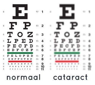 Cataract in mensentaal Cataract of staar is een vertroebeling van de ooglens. Een ooglens is normaal doorzichtig en helder, waardoor u scherp ziet. Cataract maakt de lens echter langzaam troebel.
