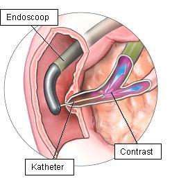 endoscoop wordt via de maag naar de twaalfvingerige darm geschoven en vervolgens voor de uitgang van de afvoergangen van de galgang en de alvleesklier (de papil van Vater).