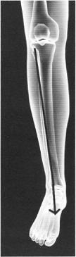 De M. Tibialis anterior onstpringt vooraan en lateraal op de tibia en volgt de laterale zijde van het scheenbeen tot aan het enkelgewricht.