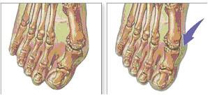 Voor Na Uw orthopedische chirurg heeft u geadviseerd om een voetoperatie te ondergaan om zo uw voetklachten te verminderen.