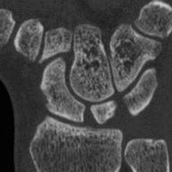 SAMENVATTING Figuur 58: Doorsnedebeeld van een MR- (links) en CT-scan (rechts) van dezelfde pols. en een groot aantal detectoren die om de patiënt heen roteren.