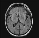 1. Wat is een CVA? Een CVA is de afkorting van een Cerebro Vasculair Accident. Het is een doorbloedingsstoornis in een hersenbloedvat.