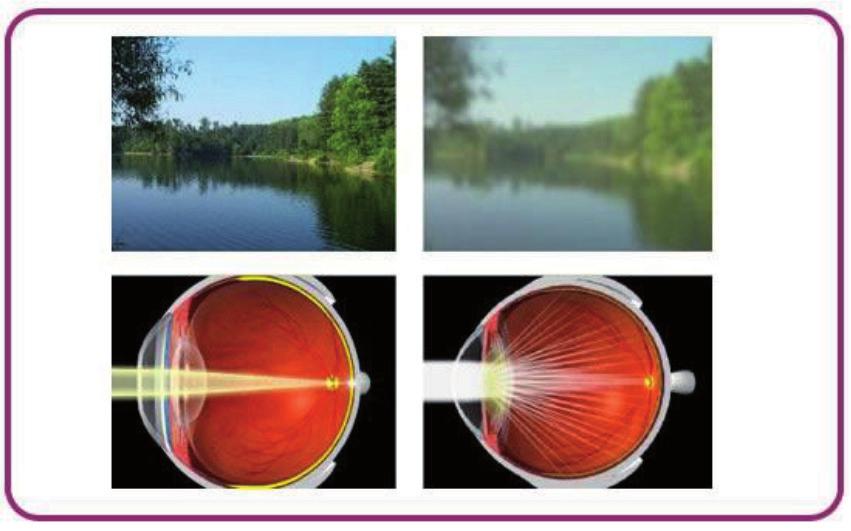 Links: heldere lens met goed zicht. Alle lichtstralen komen samen in één punt van het netvlies. Rechts: wazig zicht als gevolg van cataract.